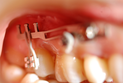 invisalign invisalign