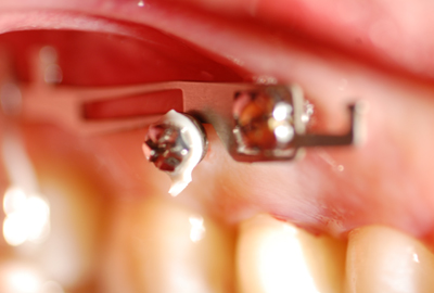 invisalign invisalign