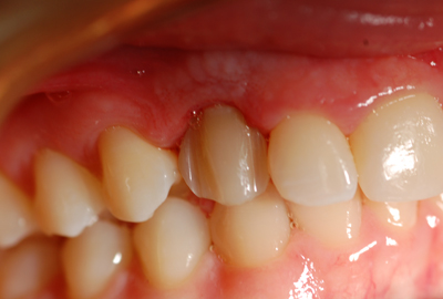 ortodonzia apparecchio denti invisibile ortodonzia apparecchio denti invisibile