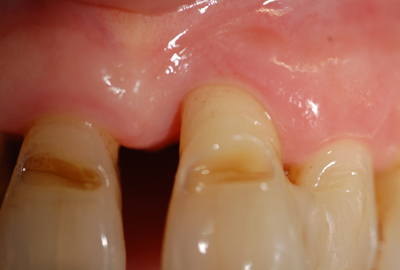 invisalign