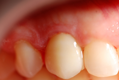 apparecchio dentale apparecchio dentale