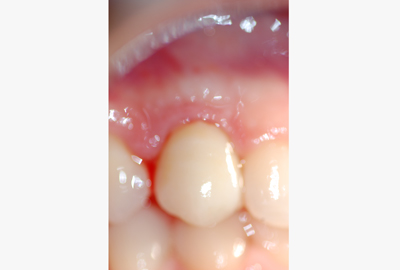 ortodonzia apparecchio denti invisibile ortodonzia apparecchio denti invisibile