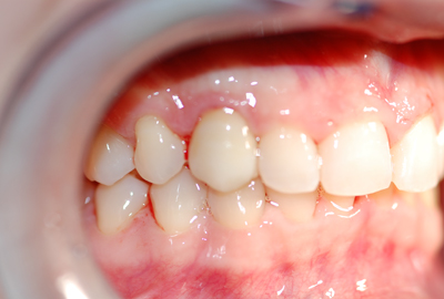 ortodonzia apparecchio denti invisibile ortodonzia apparecchio denti invisibile