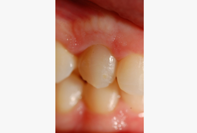 ortodonzia apparecchio denti invisibile ortodonzia apparecchio denti invisibile
