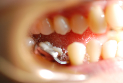 ortodonzia bambini