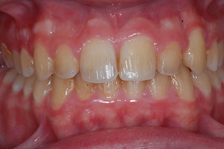 ortodonzia apparecchio denti invisibile