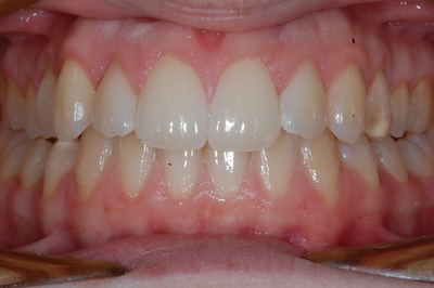ortodonzia apparecchio denti invisibile ortodonzia apparecchio denti invisibile