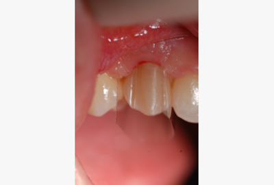 invisalign invisalign