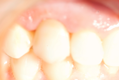 apparecchio dentale apparecchio dentale