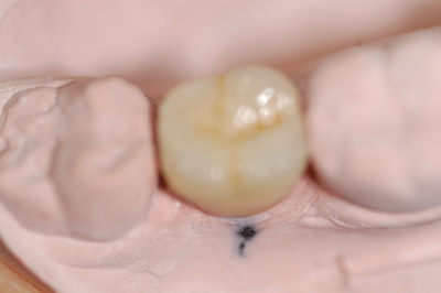 invisalign