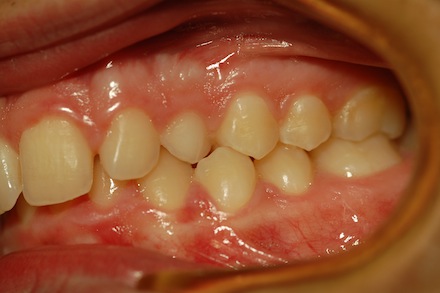 ortodonzia apparecchio denti invisibile ortodonzia apparecchio denti invisibile