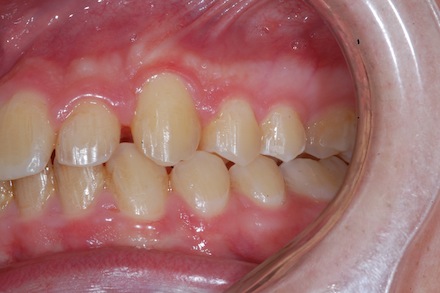 invisalign invisalign
