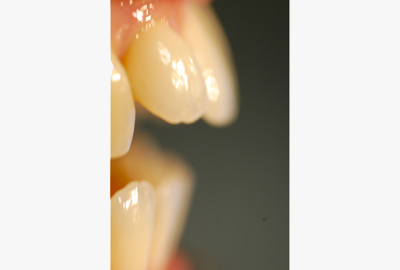 apparecchio dentale apparecchio dentale