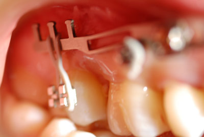 invisalign invisalign