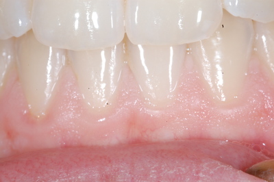 invisalign invisalign