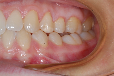 apparecchio per denti apparecchio per denti