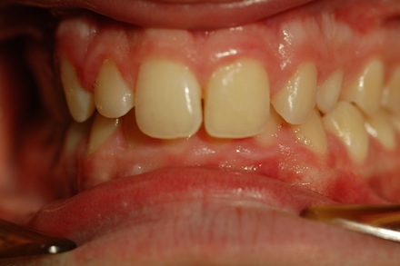 invisalign invisalign