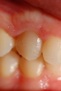 invisalign invisalign