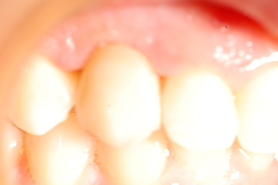 apparecchio per denti apparecchio per denti