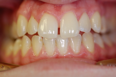 ortodonzia apparecchio denti invisibile ortodonzia apparecchio denti invisibile