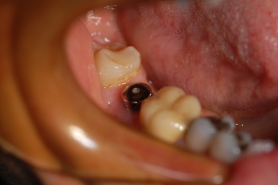 invisalign