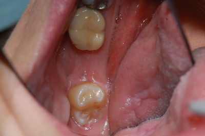 ortodonzia apparecchio denti invisibile