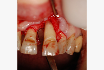 apparecchio per denti