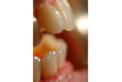 ortodonzia apparecchio denti invisibile ortodonzia apparecchio denti invisibile